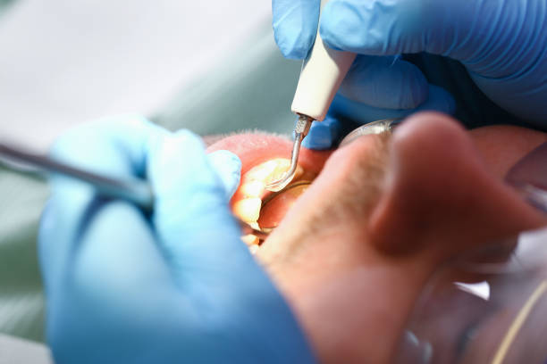 Best Chipped Tooth Repair Near Me  in Covington, OH