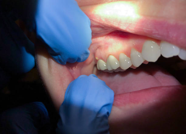 Best Tooth Infection Emergency Dentist  in Covington, OH
