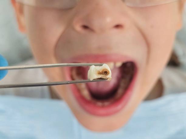 Best Urgent Tooth Repair  in Covington, OH